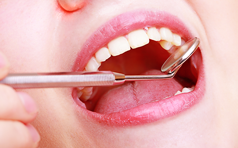 歯のクリーニング