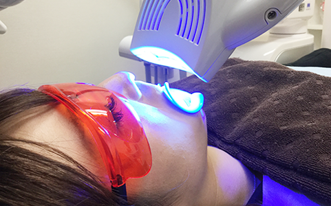 ホワイトニング薬剤の塗布・光照射